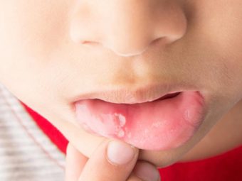 儿童口腔溃疡-原因，治疗和补救