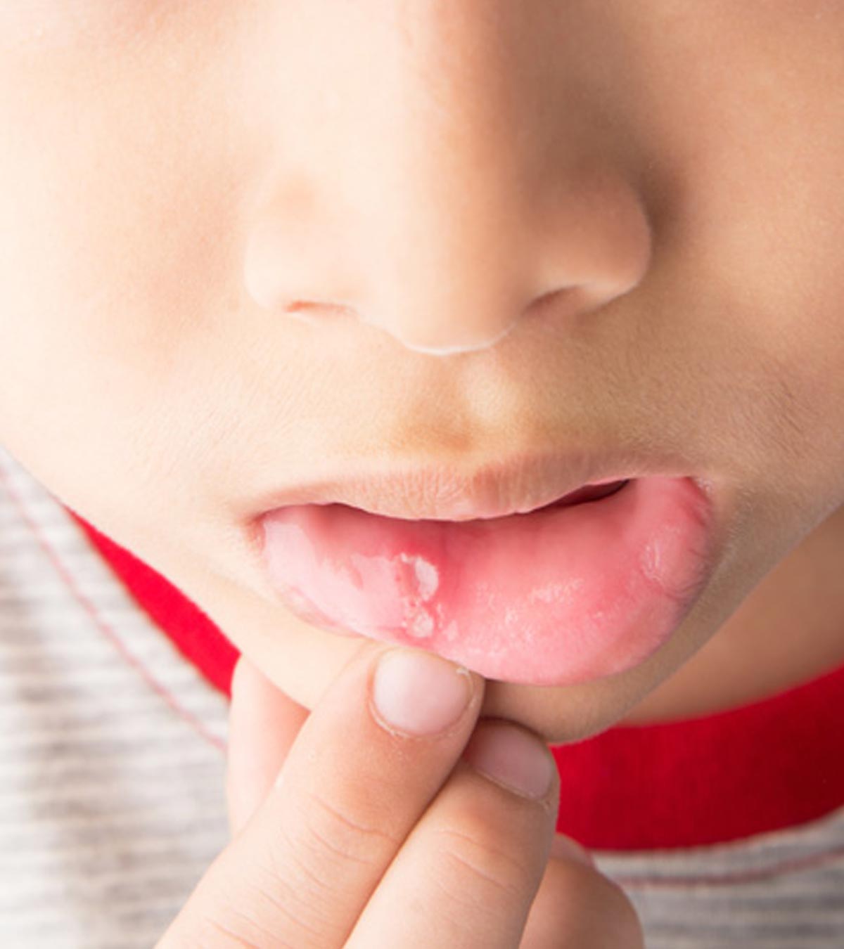 儿童口腔溃疡的病因、症状和治疗