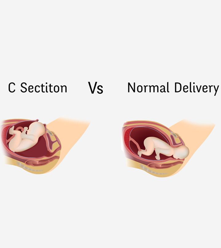 正常分娩Vs剖宫产——风险和益处