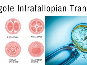Infertility Treatment - Zygote Intrafallopian Transfer (ZIFT)