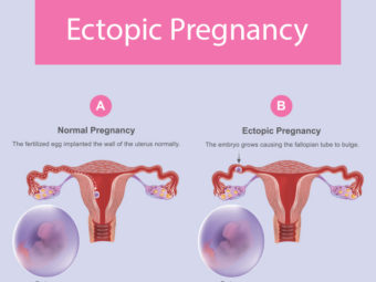 Ectopic Pregnancy Causes, Symptoms, Treatment, And Risks