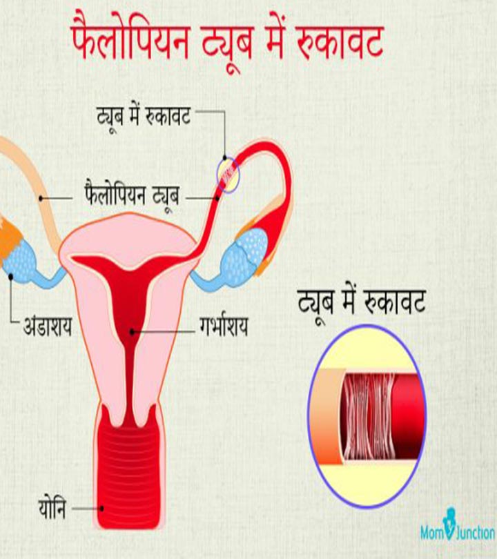 फैलोपियनट्यूबरुकावट:लक्षण,उपचारवलागत|输卵管堵塞治疗在印地语