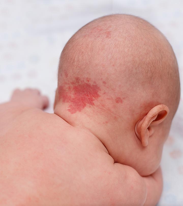 What To Know About Birthmarks