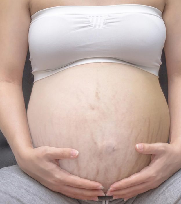 Are Pregnancy Stretch Marks Worrying You? Here’s What You Can Do!