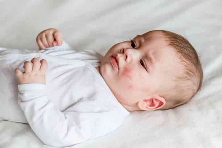 益生元有助于控制婴儿的特应性湿疹。