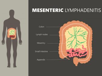 Mesenteric Lymphadenitis In Children: Causes And Treatment