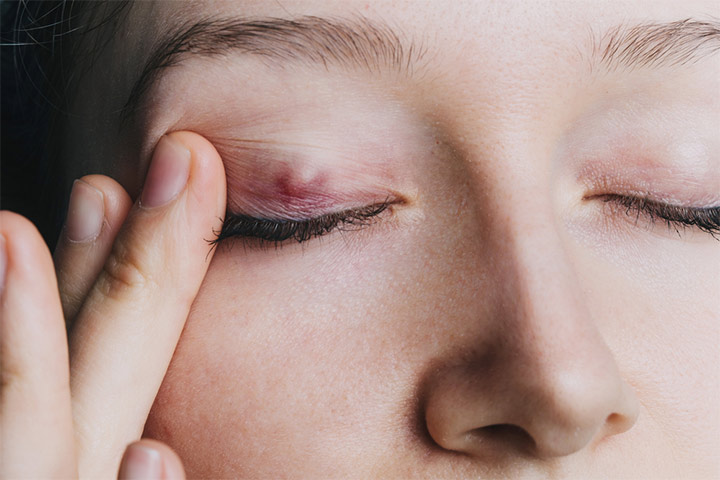 Chalazion, swollen eyelids in children