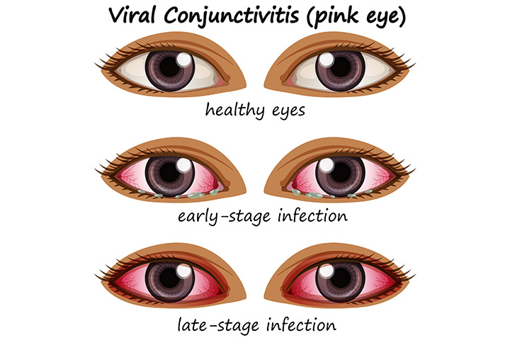 Viral conjunctivitis, swollen eyelids in children