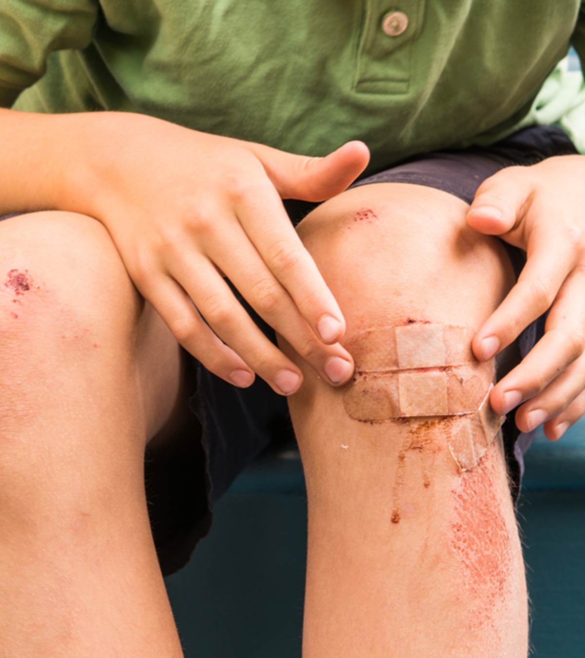 儿童异常瘀伤:体征、原因和治疗