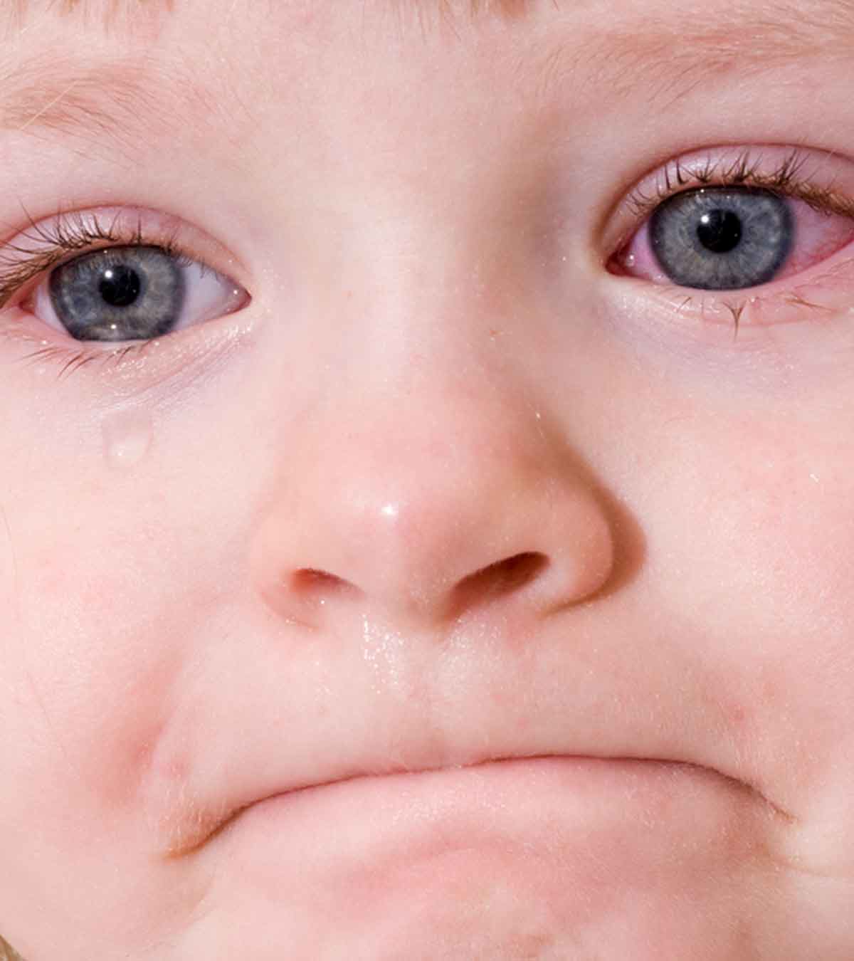 儿童红眼病(结膜炎):13种症状及治疗