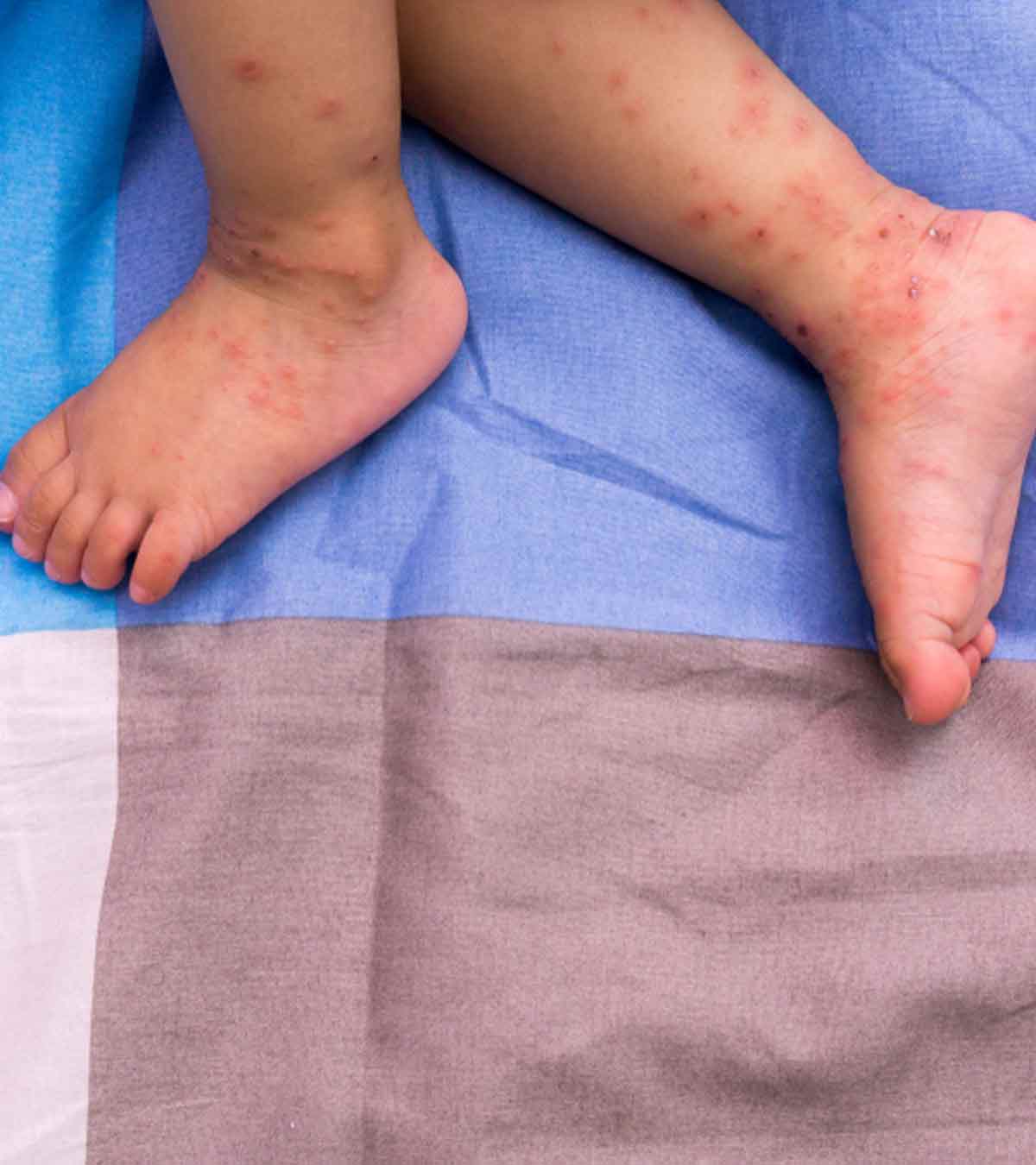 婴儿出生疱疹:原因，症状和预防