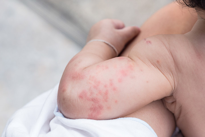婴儿荨麻疹