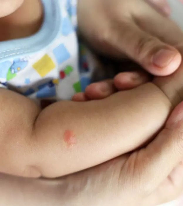 婴儿身上的跳蚤叮咬:它们的样子、治疗和预防