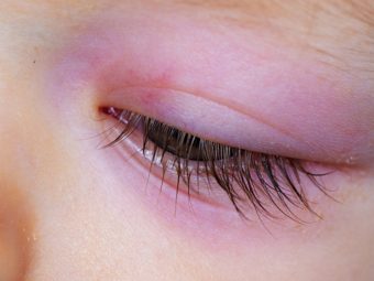 婴儿眼肿:原因、治疗和家庭补救