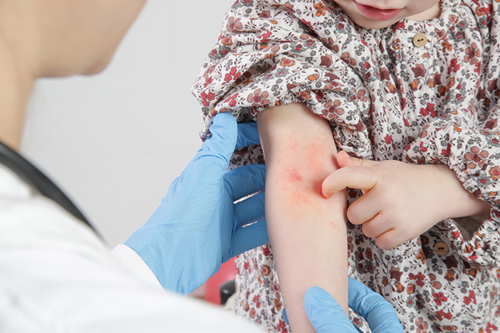中毒性休克综合征的症状包括皮肤出现皮疹