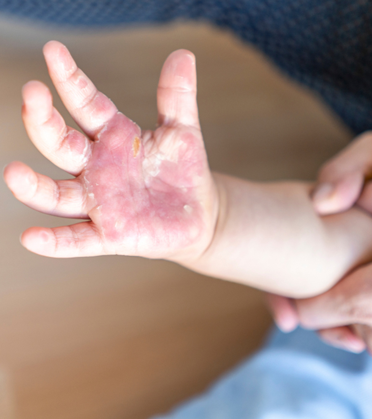 儿童烧伤:治疗和家庭疗法