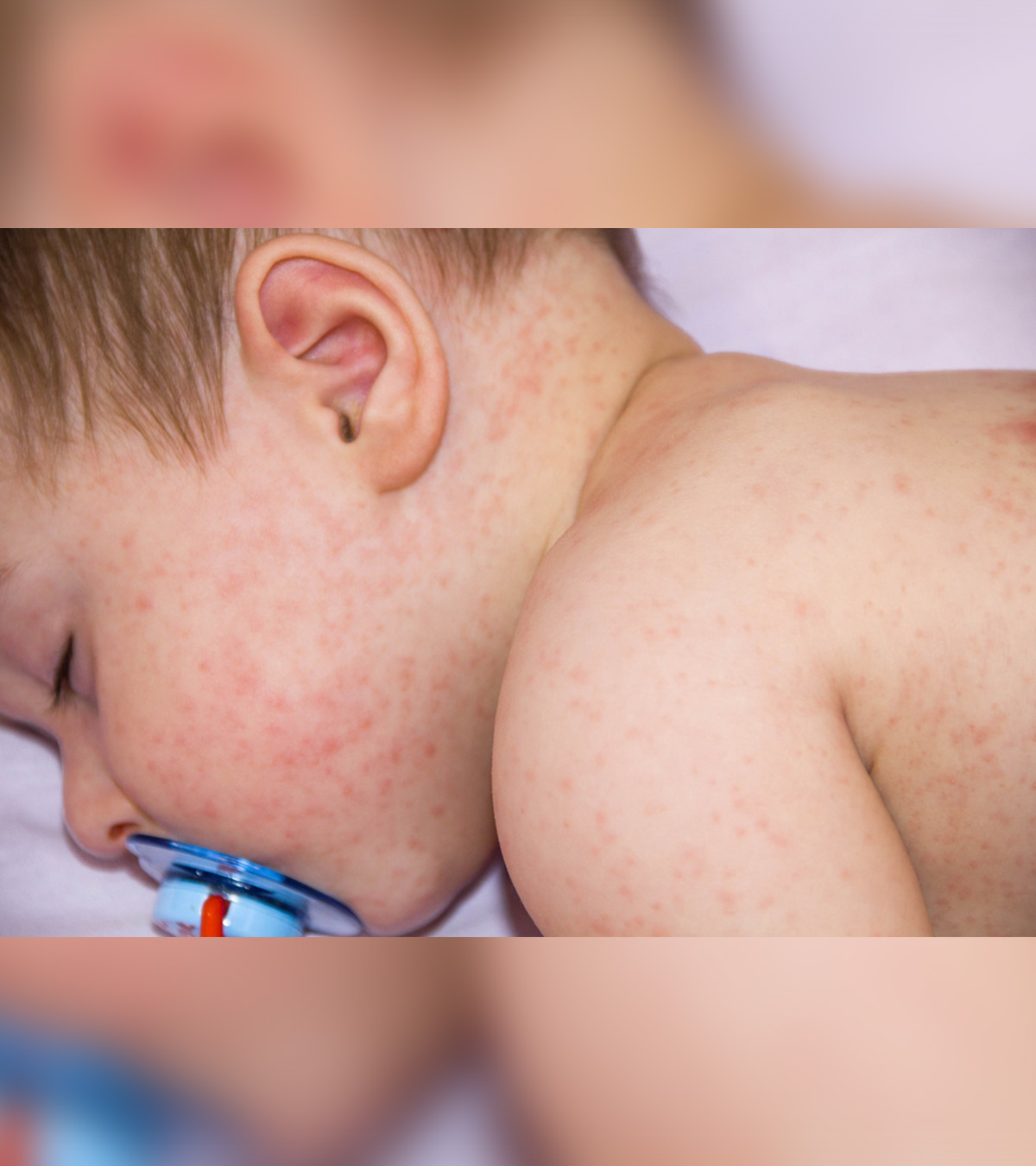 幼儿发烧后的皮疹:原因和处理方法万博体育手机官方网站登录