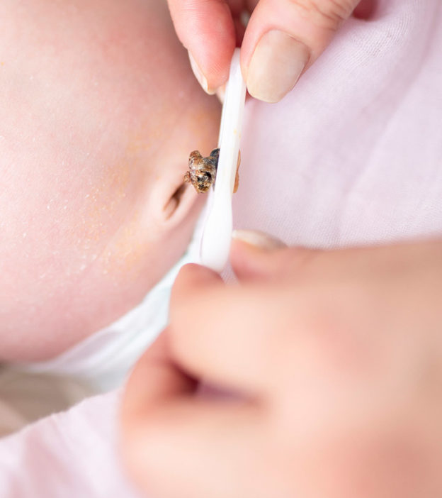 婴儿脐部肉芽肿:原因、治疗和护理