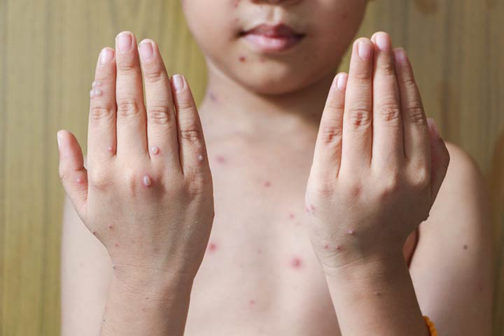 儿童病毒性皮疹，水痘