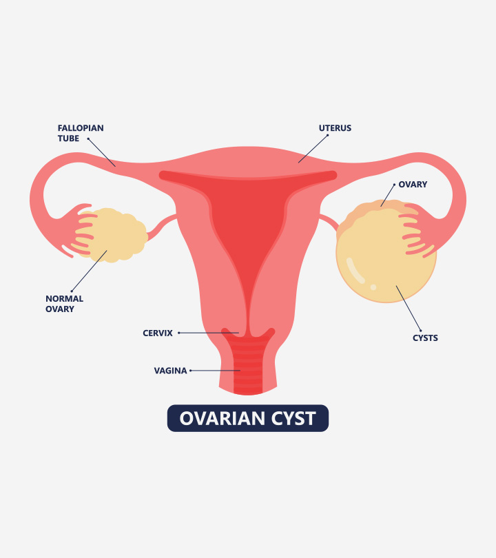妊娠期卵巢囊肿:类型、症状和manbet安卓版治疗