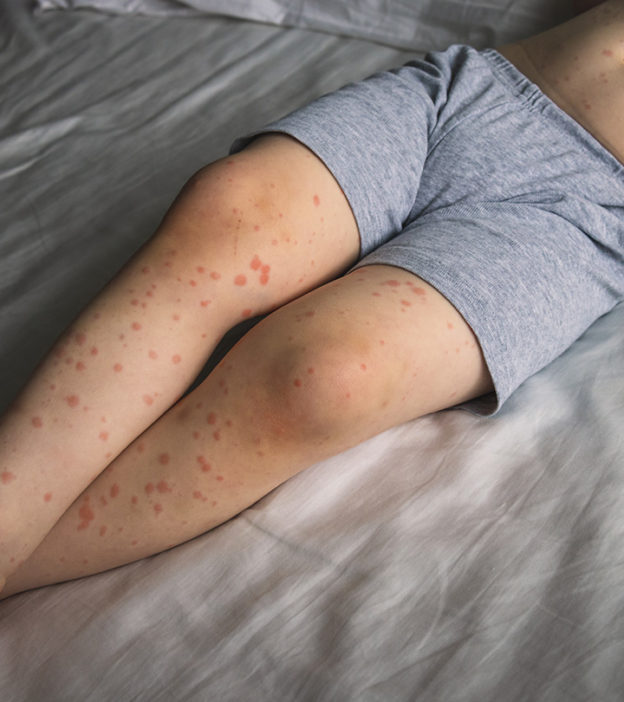 儿童玫瑰疹:症状、原因、治疗和预防
