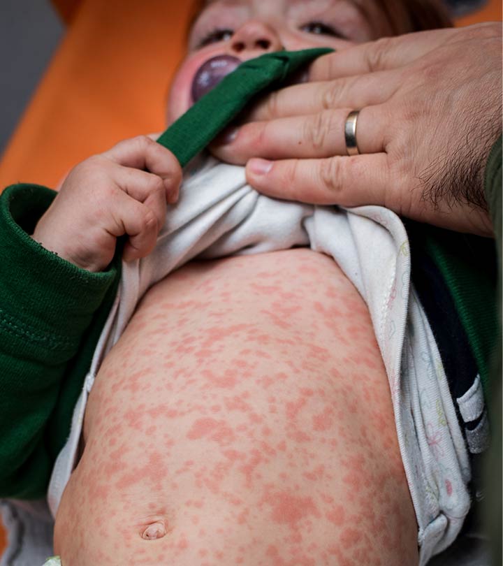儿童病毒性皮疹:类型、图片、治疗和预防