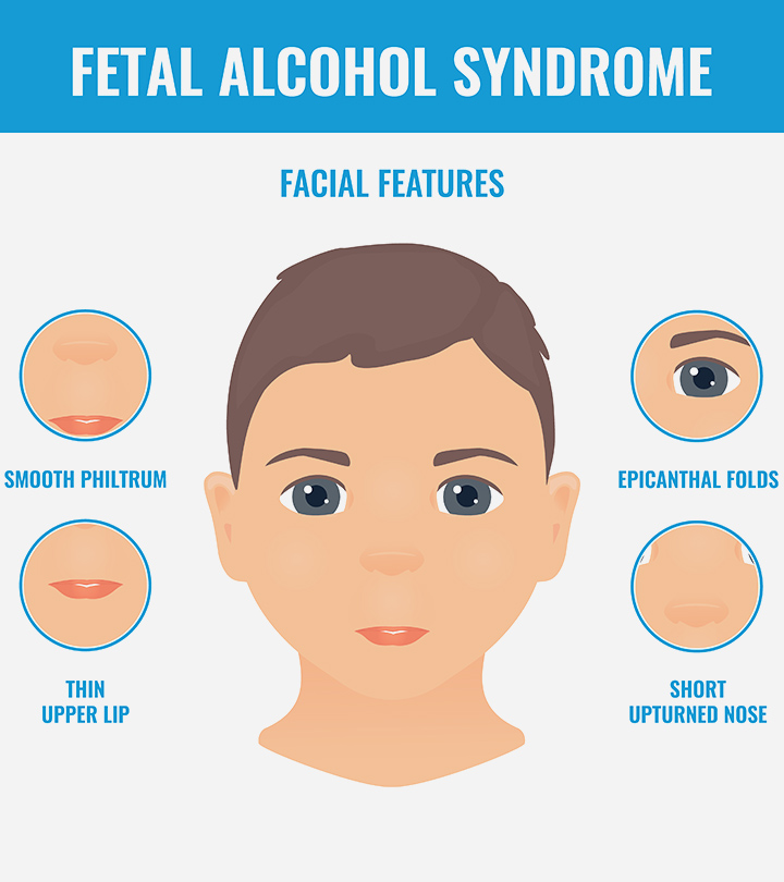 胎儿酒精综合症(FAS):原因、症状和治疗