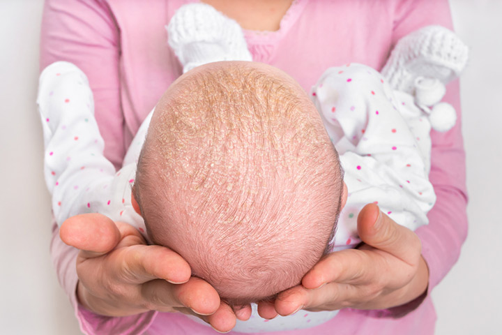 一种自身免疫性疾病,导致快速newborn skin peeling