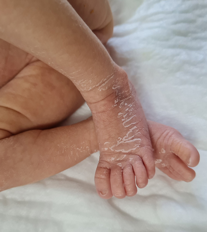 新生儿皮肤脱皮的原因和治疗方法?