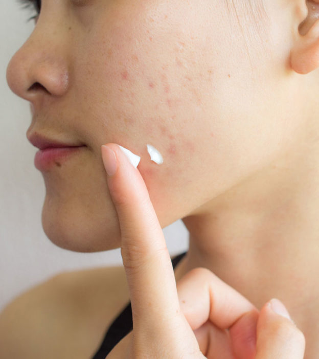 10 Home Remedies For Acne During Pregnancy & Prevention Tips