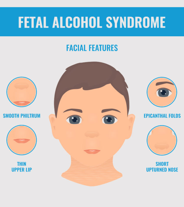胎儿酒精综合征(FAS):症状与治疗
