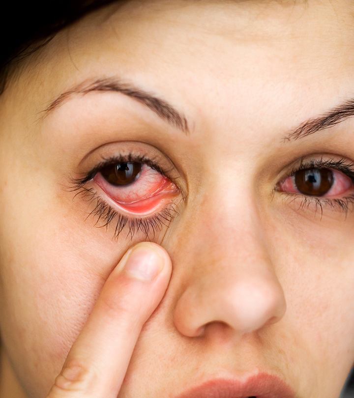 妊娠期结膜炎(红眼):症状、原因和治疗