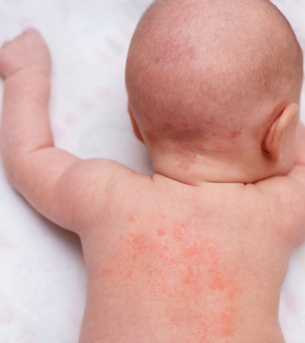 婴儿热疹:类型，症状和治疗