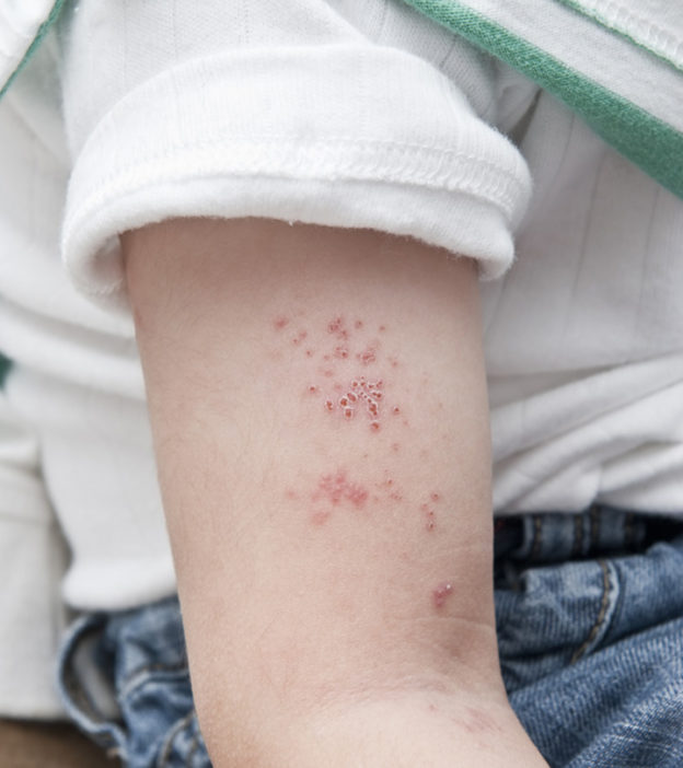 儿童带状疱疹:病因、治疗和预防