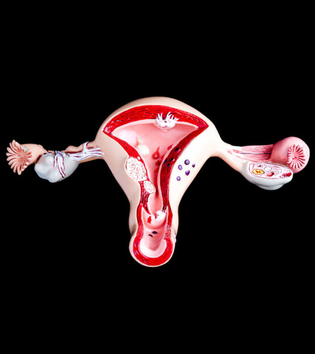 子宫内膜异位症如何怀孕?机会和最佳年龄