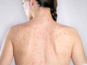 Shingles In Pregnancy Causes, Symptoms And Treatment