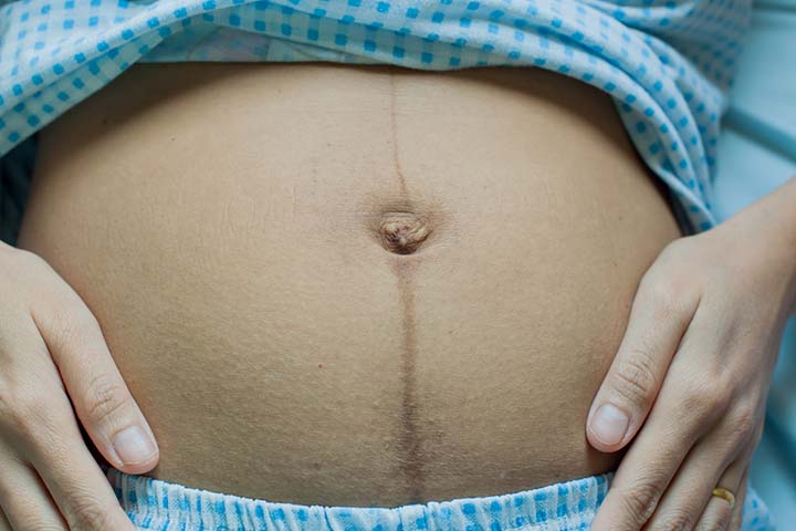 manbet安卓版在怀孕期间，肚脐周围的皮肤变得松弛。