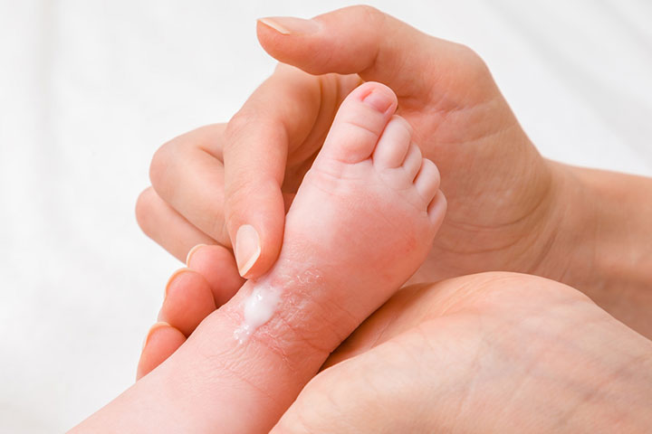 湿疹是婴儿的皮肤问题