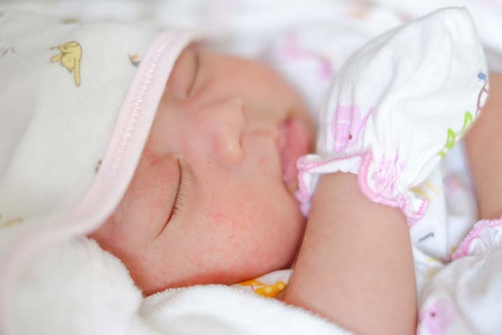 新生儿中毒性红斑皮疹可从面部开始