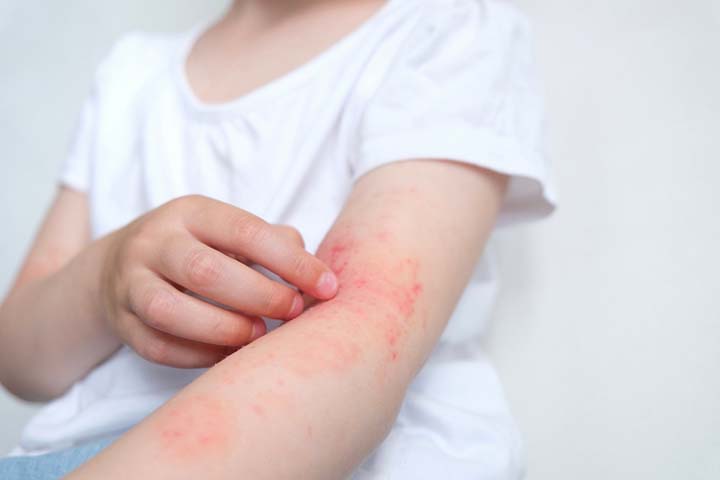 真菌性皮肤感染是儿童的常见病