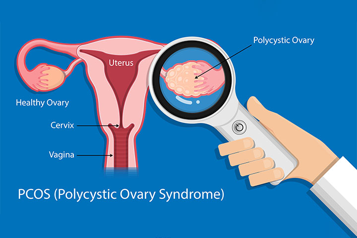 多囊卵巢综合征可能会引起排卵障碍或没有排卵