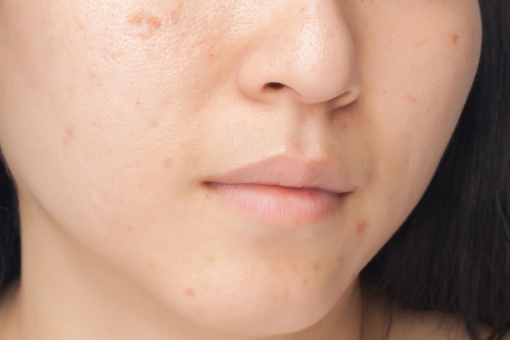 产后皮肤护理可以帮助预防痤疮