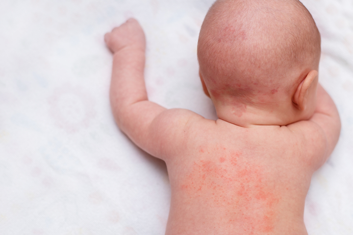 如果宝宝出现皮疹或水泡，请去看医生。