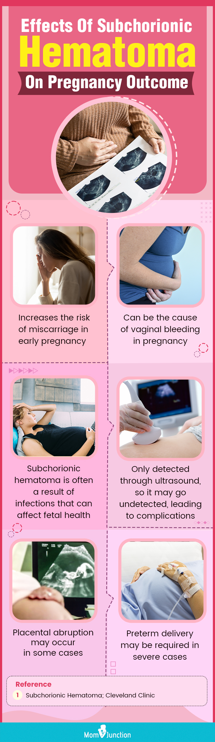 绒毛膜下血肿对妊娠结局的影响(信息图)